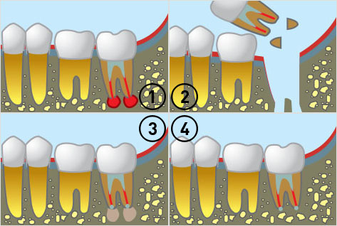 치아를 재 이식하는 4단계 이미지