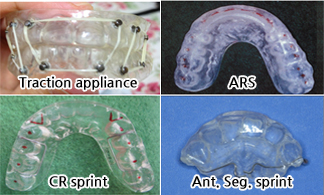 교합장치 치료 관련이미지